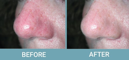 Facial-Thread-Vein-Removal-before-after