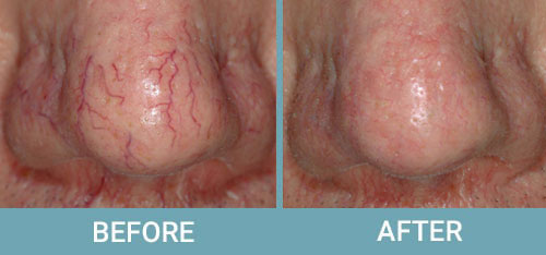 Facial-Thread-Vein-Removal-before-after