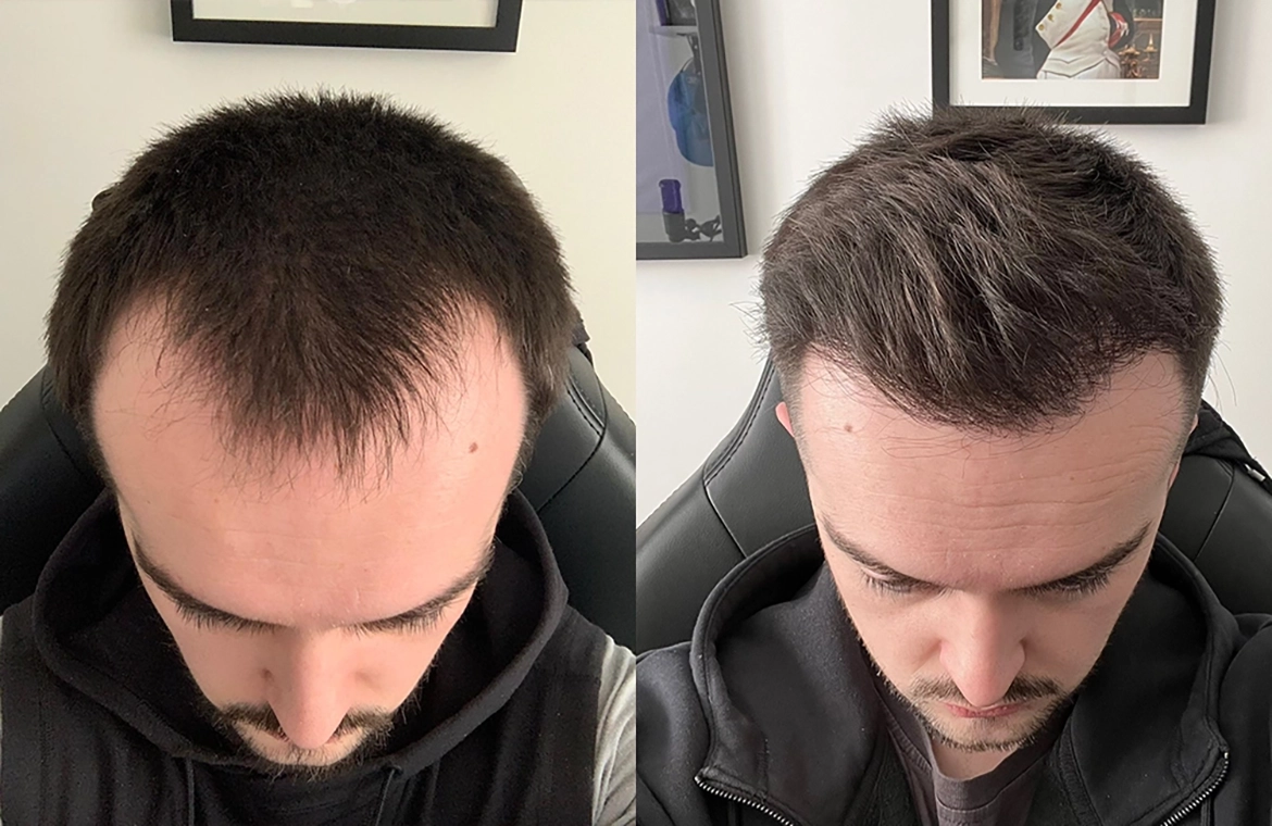 Hair-Loss-Before-And-After (1)
