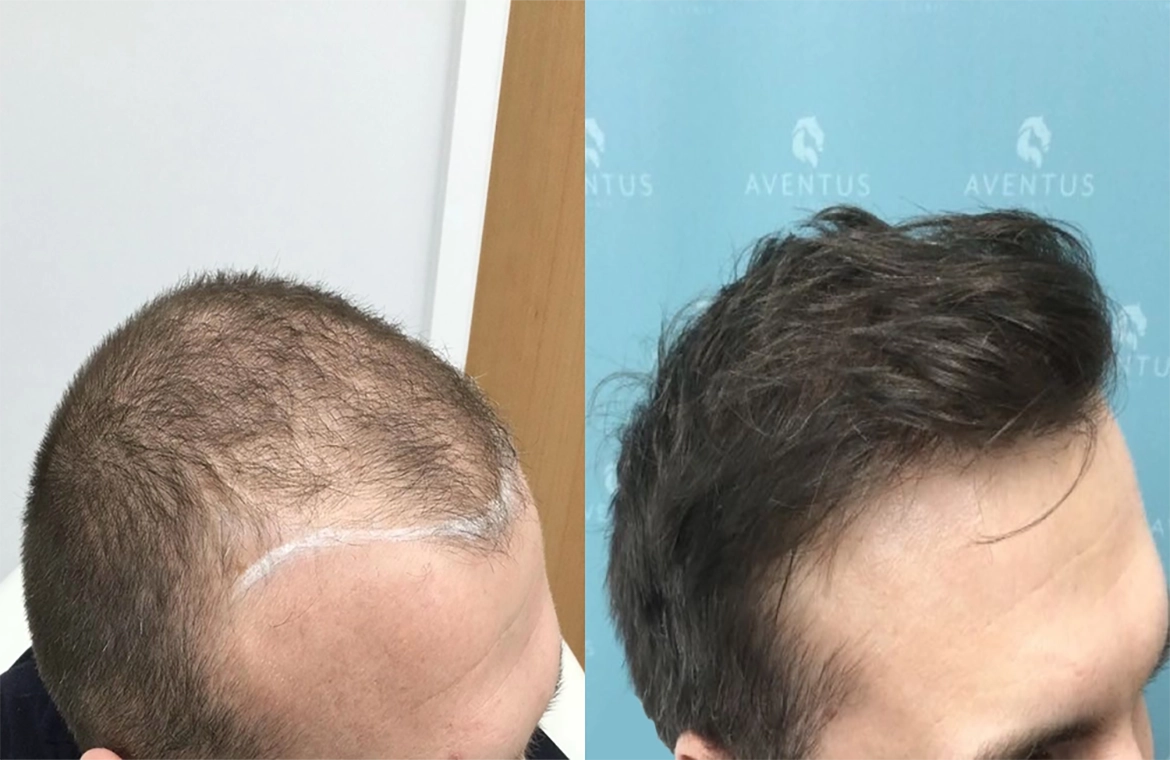Hair-Loss-Before-And-After1
