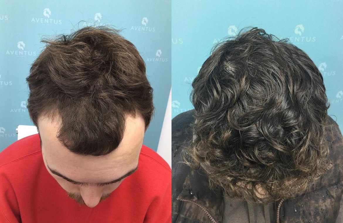 Non-Surgical-Hair-Treatment-Before-And-After2