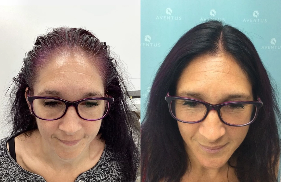Non-Surgical-Hair-Treatment-Before-And-After3