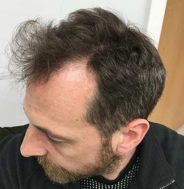 Hairline-Transplant-Journey-1