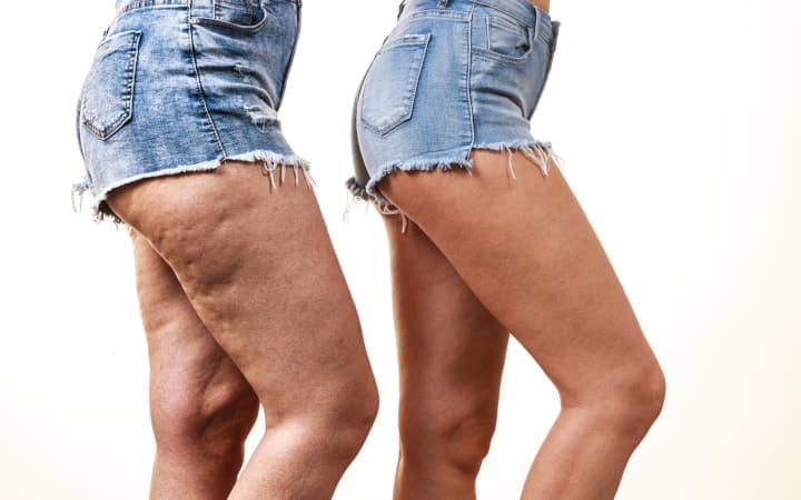 Can Aminophylline Reduce Cellulite