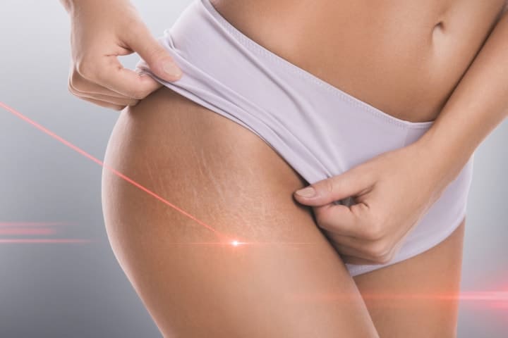 How to Eliminate Stretch Marks