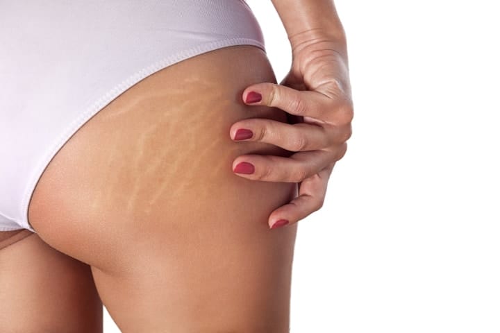 Remove Stretch Marks