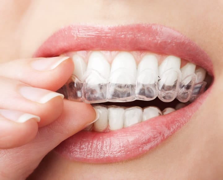 Which Teeth Whitening Products Work Best?