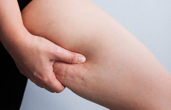 What causes cellulite?