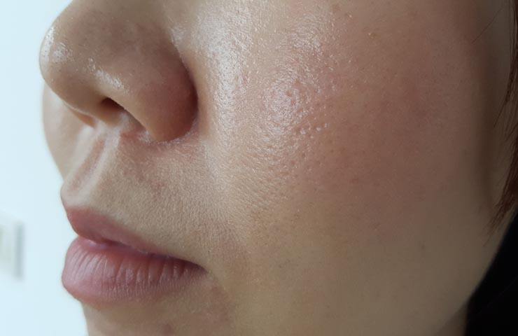 Enlarged pores are a sign of oily skin.