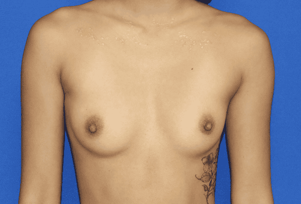 Breast Augmentation before and after - before