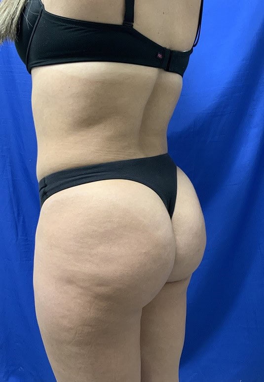 BBL before and after - after