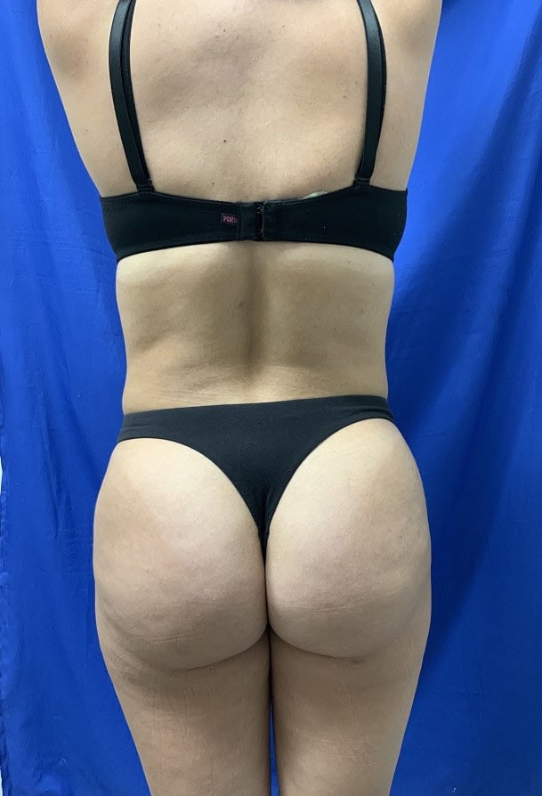 BBL before and after - after