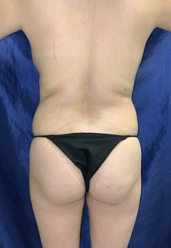 BBL before and after - before