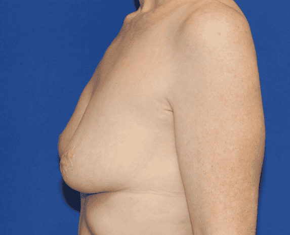 Breast Lift before and after - before