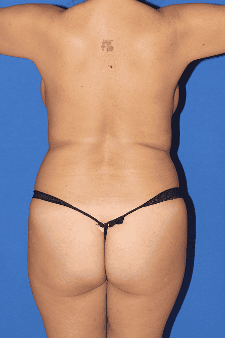 BBL before and after - before