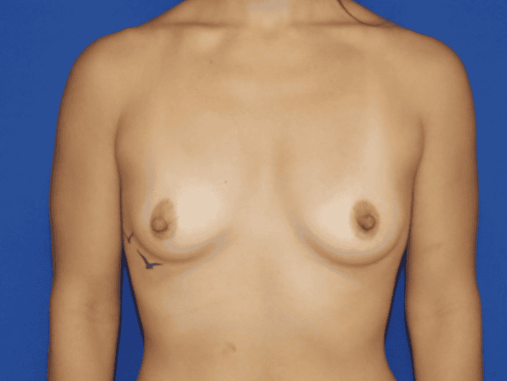 Breast Augmentation before and after - before