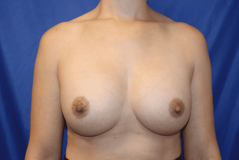 Breast Augmentation before and after - after