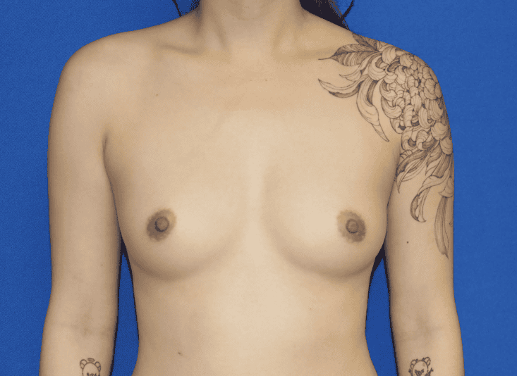 Breast Augmentation before and after - before