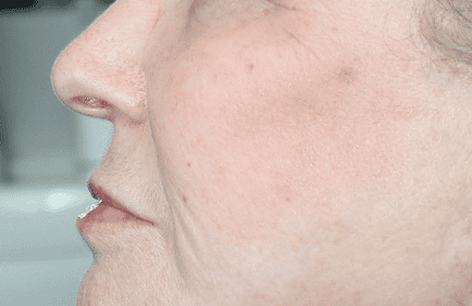 Procedure before and after - after