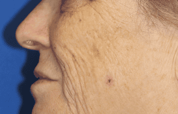 Procedure before and after - before