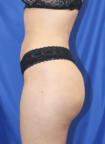 BBL before and after - after