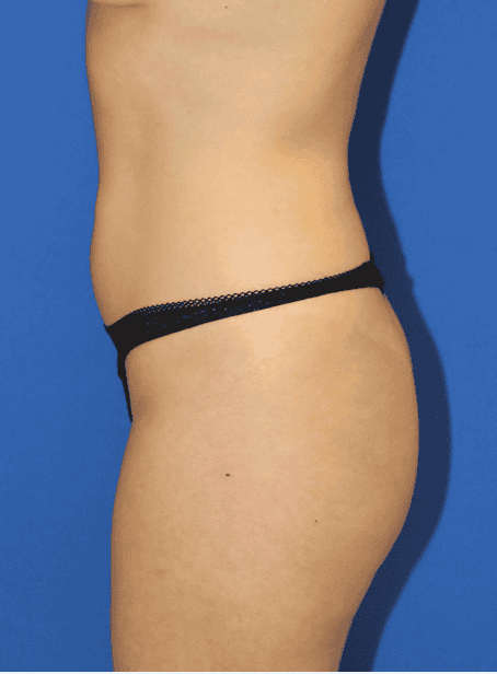 BBL before and after - before