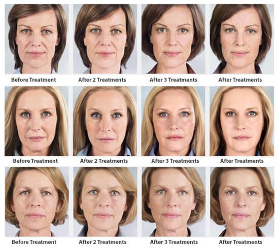 Before & After Sculptra
