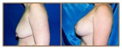 Breast Lift