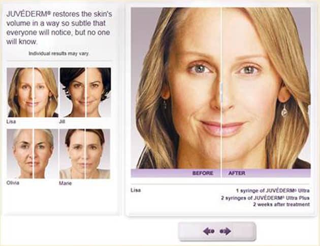 Juvederm Information