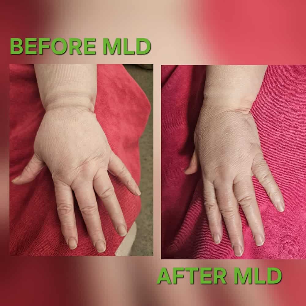 Before and after comparison of manual lymphatic drainage (MLD) on a hand. The 'before' image on the left shows a hand with visible swelling in the wrist and hand area. The 'after' image on the right shows the same hand with noticeably reduced swelling, revealing more defined bone structure and reduced puffiness.