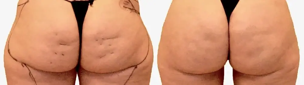 Thigh liposuction before and after, actual patient of Dr. Long