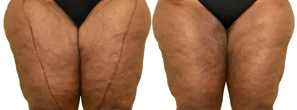 Thigh liposuction before and after, actual patient of Dr. Long