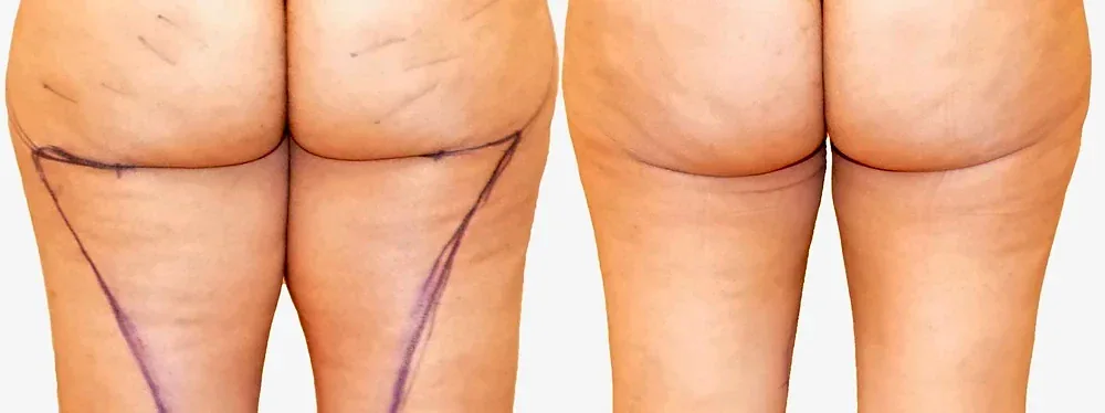 Thigh liposuction before and after, actual patient of Dr. Long