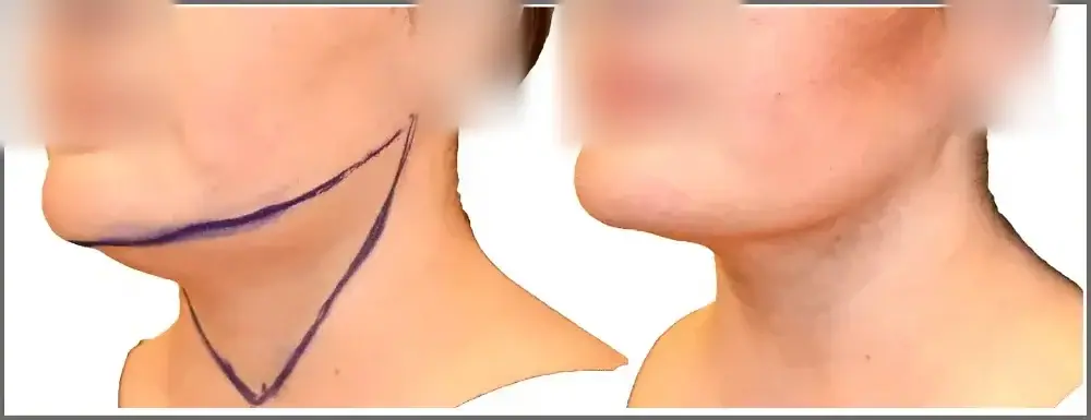 Chin and neck liposuction before and after, actual patient of Dr. Long