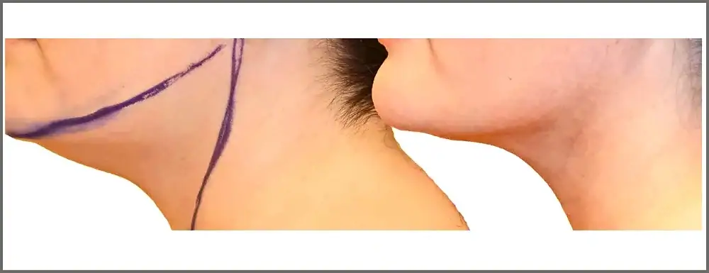 Chin and neck liposuction before and after, actual patient of Dr. Long