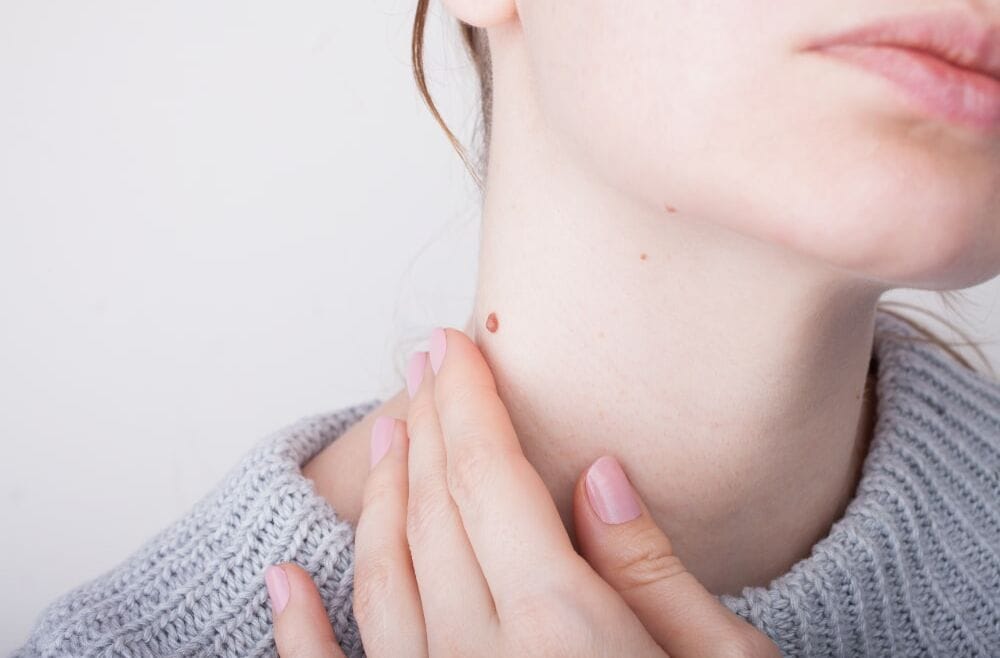 Wart Removal