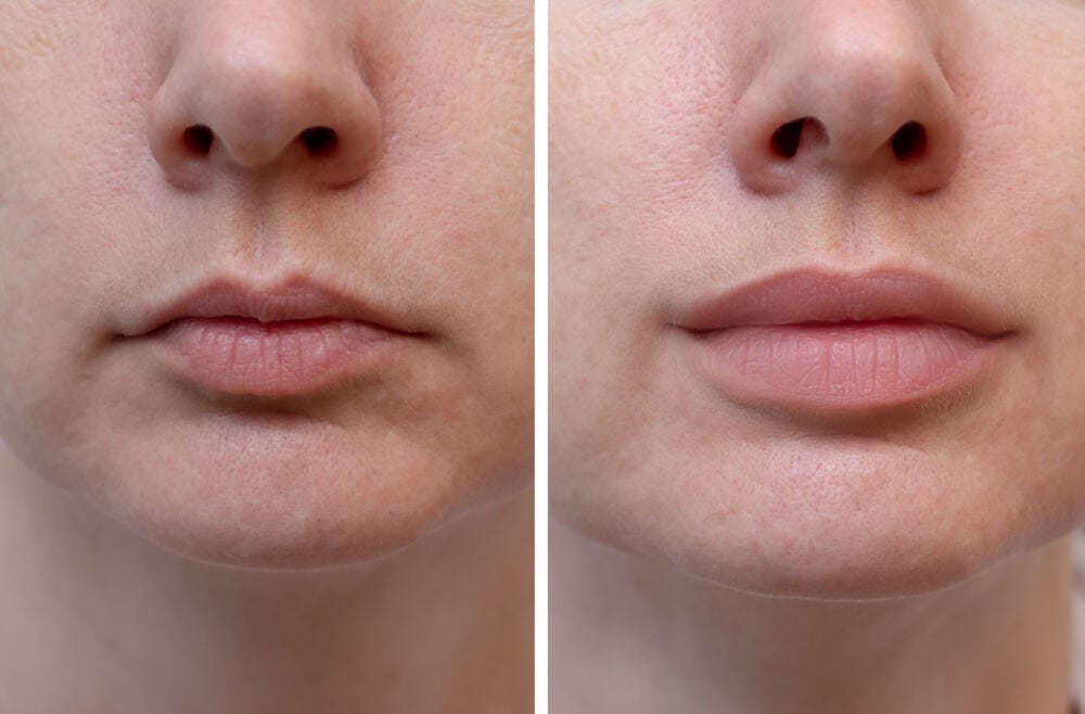 Lip Filler
