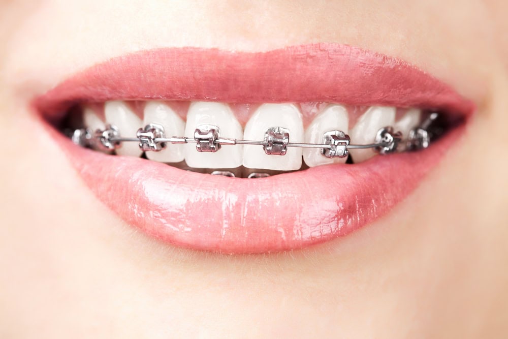 Metaliskās breketes. Metallic braces