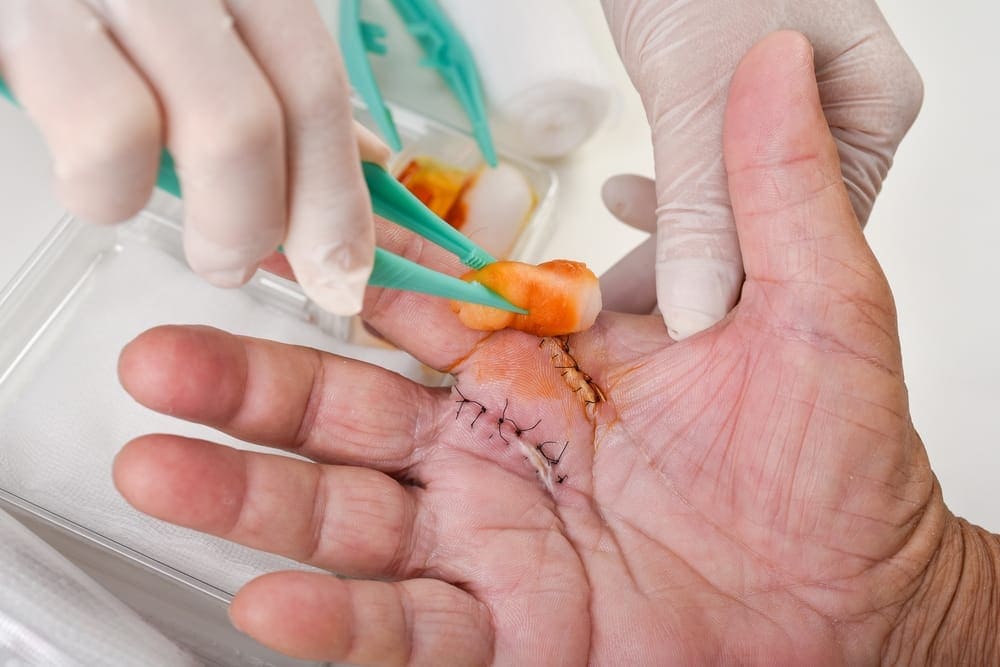 Common Myths and Facts About Hand Surgery