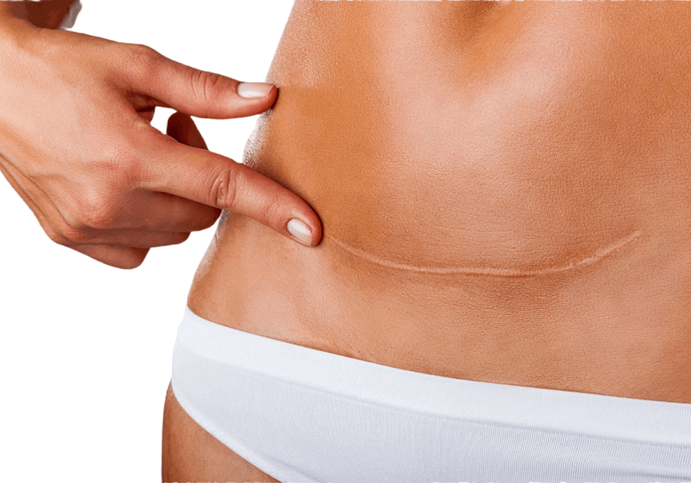 Lipectomía y abdominoplastia, procedimiento en Clínica Fontana Valencia