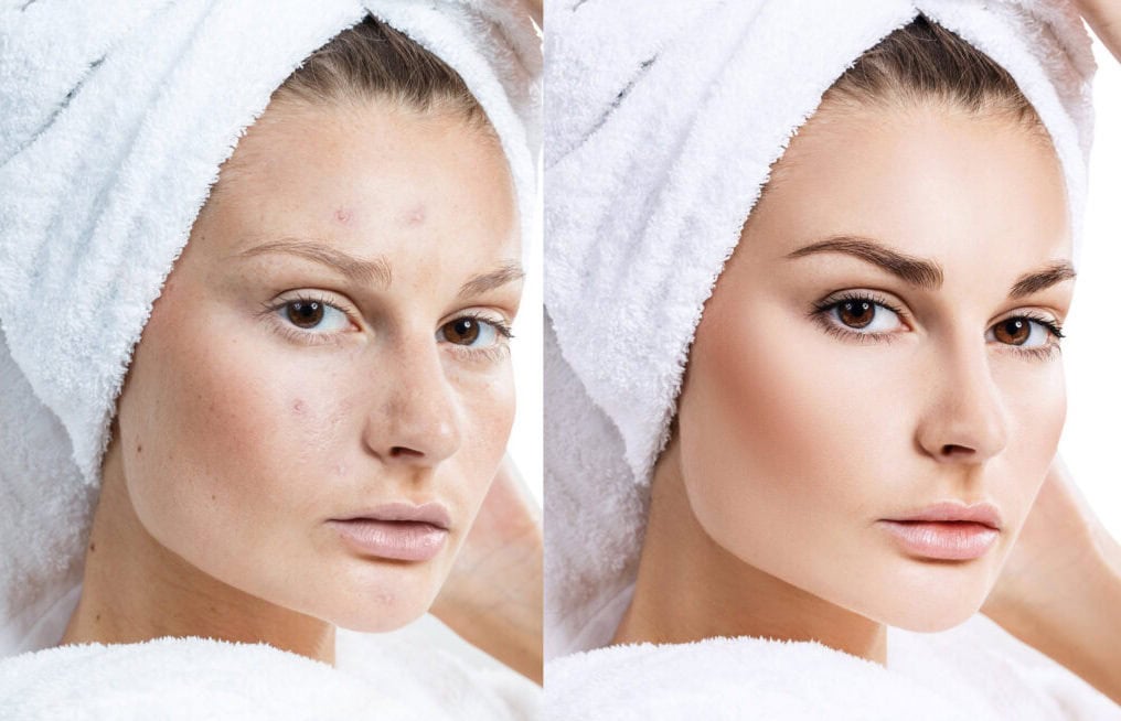 Young woman before and after treatment.