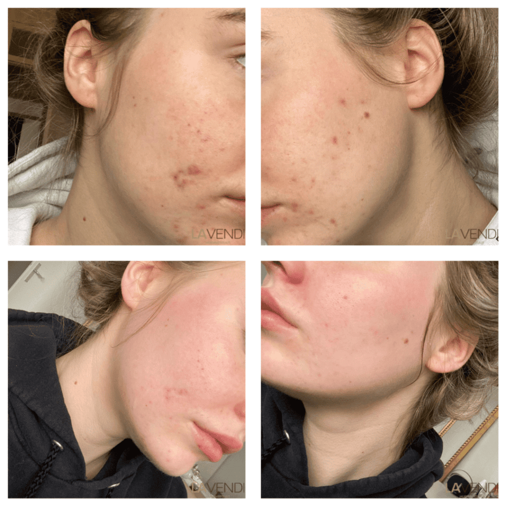 voor-na-dermapen4