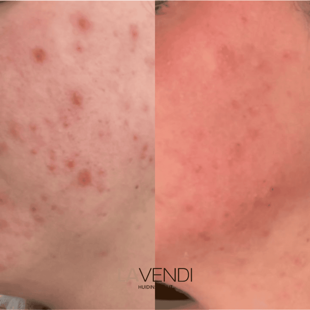 acne voor na