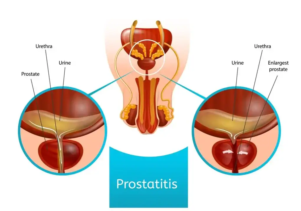 Prostatite
