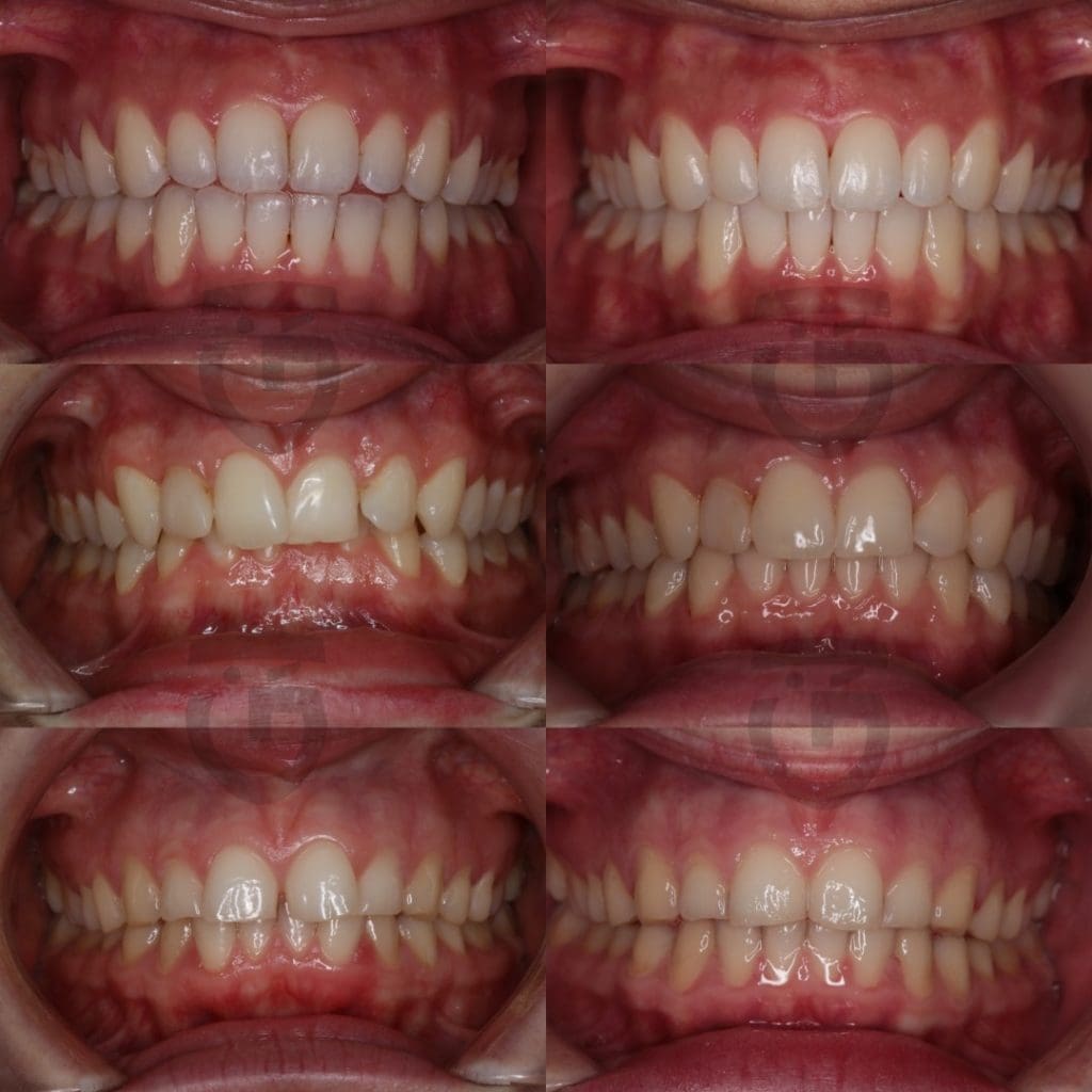 Pirms un pec caurspidigas kapes