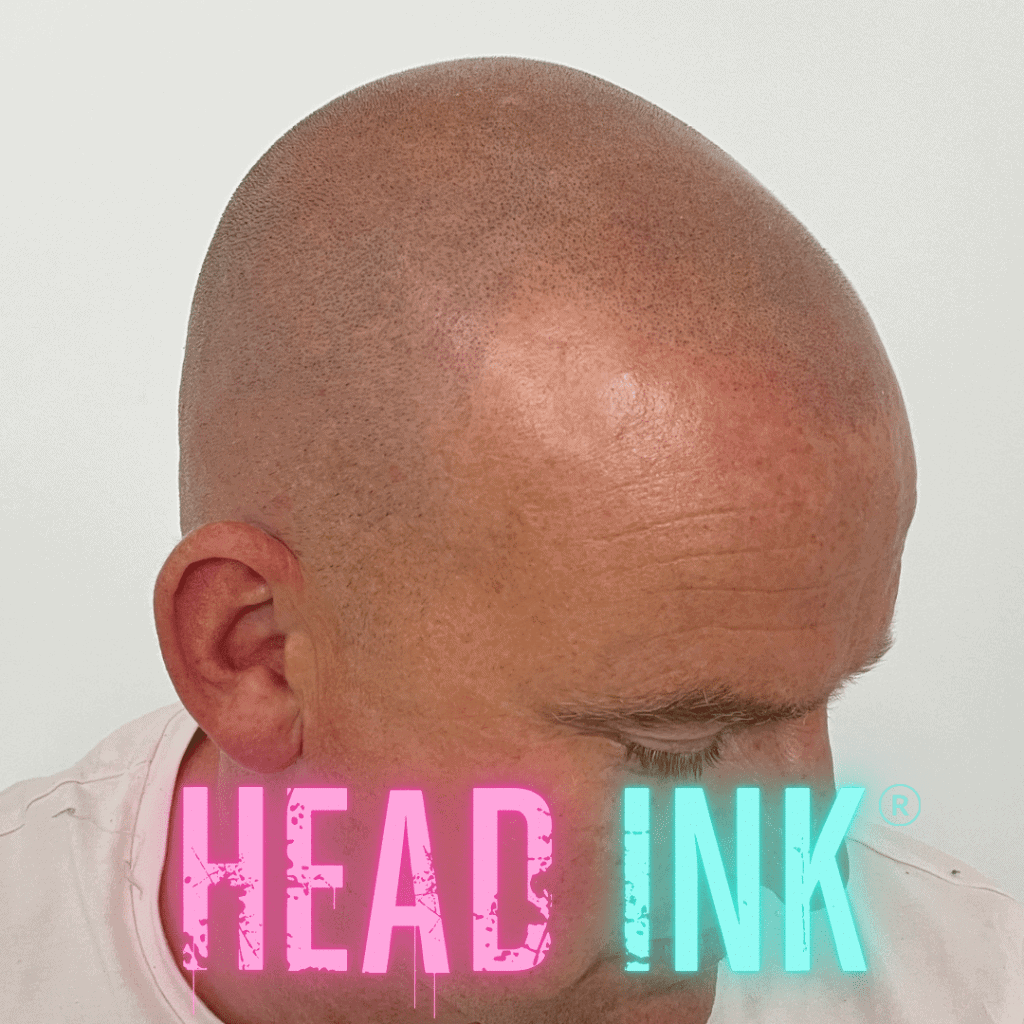 Scalp Micropigmentation