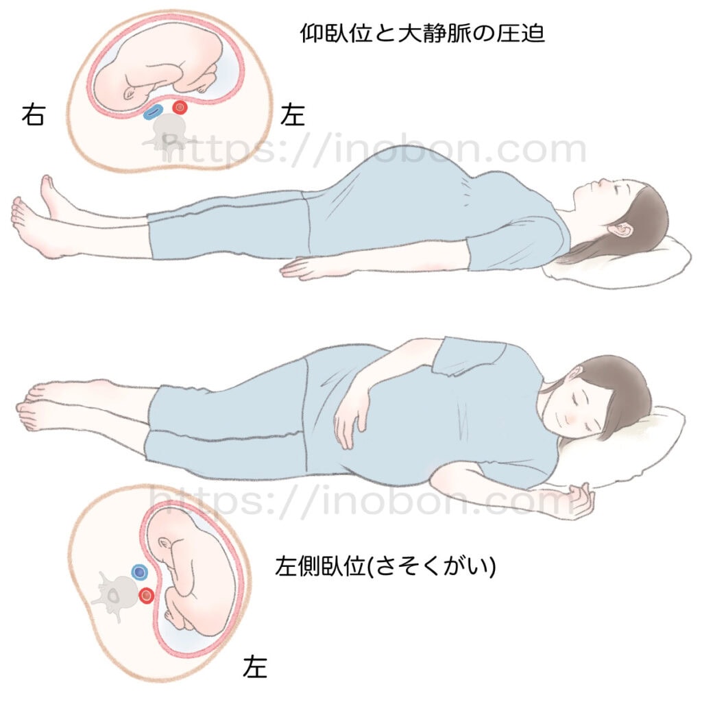 横になって眠る妊婦、妊娠時の大静脈の圧迫
