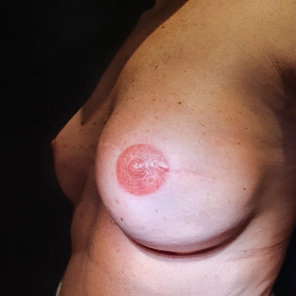 micropigmentación-areolar