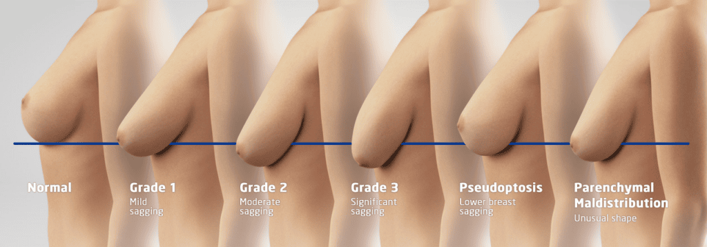 stages of sagging