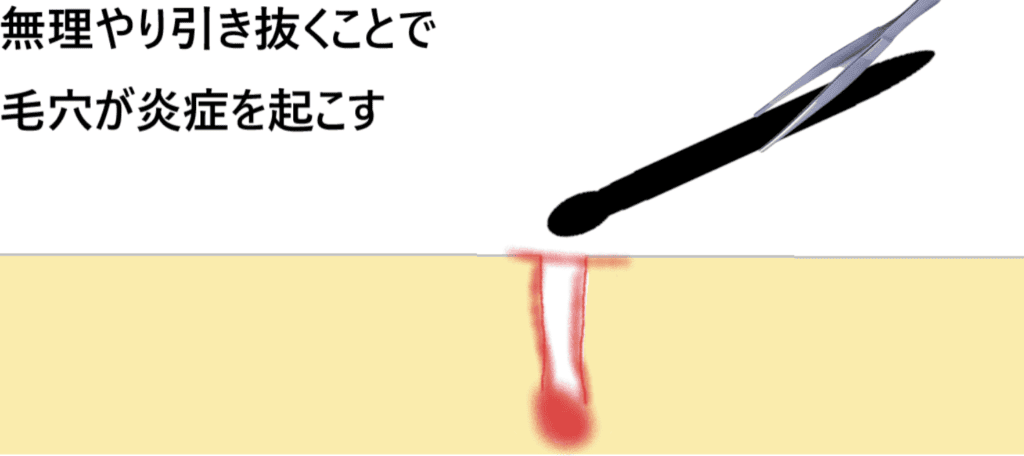 毛を引き抜くと、目に見えない単位で出血する